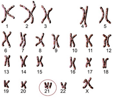 Người mắc hội chứng Down có 3 nhiễm sắc thể trong cặp nhiễm sắc thể 21