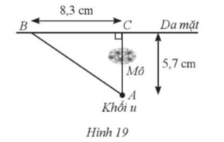 Một khối u (ở vị trí A ) của một bệnh nhân cách da mặt 5,7 cm