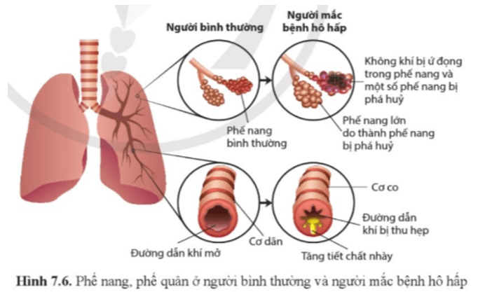 Quan sát hình 7.6, nêu sự khác biệt ở phế nang và phế quản giữa người bình thường và người mắc bệnh hô hấp